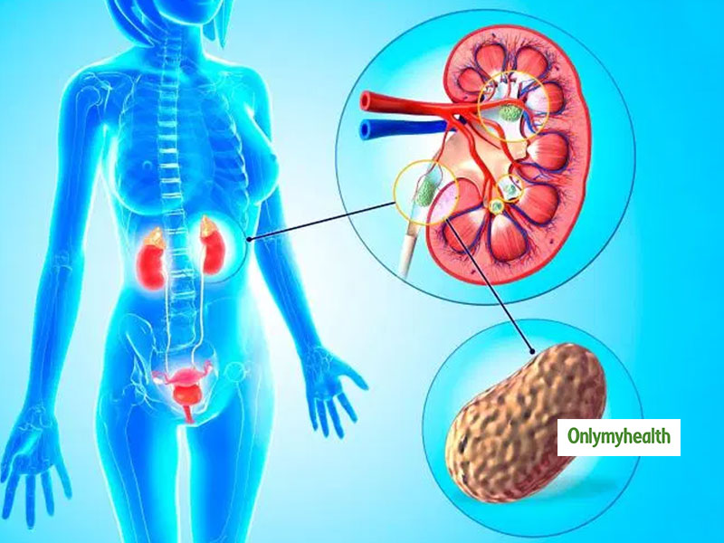 Kidney Stone Prognosis: Know Everything About The Diagnosis And Its After Care